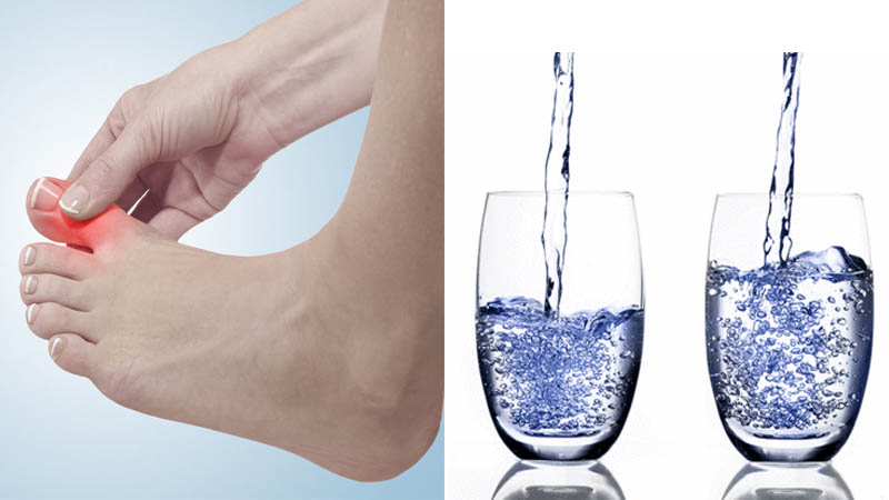 Nước khoáng Trim Ion hỗ trợ điều trị bệnh Gout